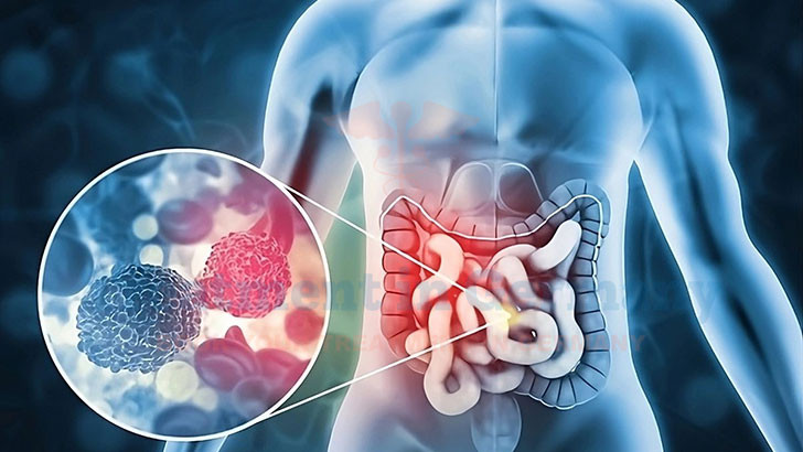 Stage 4 Colon Cancer Treatment in Germany