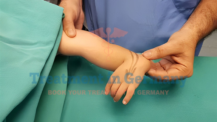 Radial Club Hand Treatment in Germany