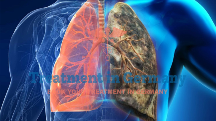 Hope for Stage 4 Lung Cancer Patients: Treatment Options in Germany