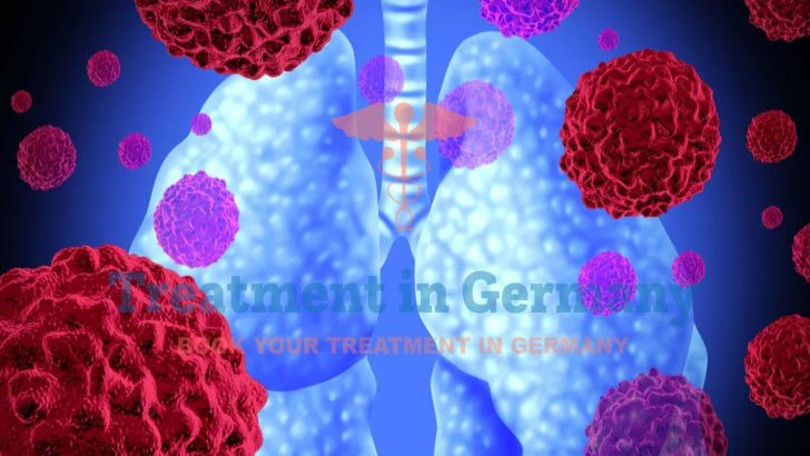 Is Dendritic Cell Therapy Effective for Non-Small Cell Lung Cancer?