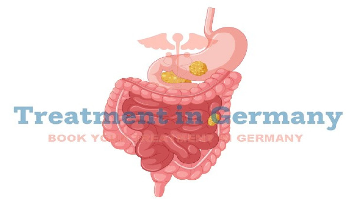 Advances in the Treatment of Gastrointestinal Neuroendocrine Tumors in Germany