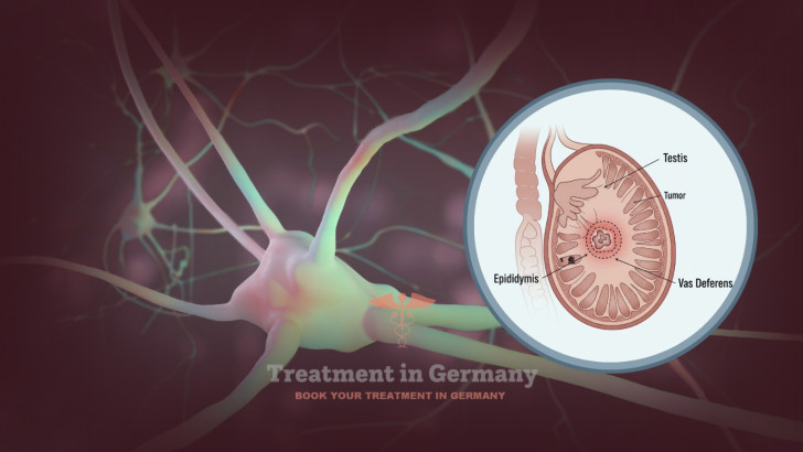Dendritic Cell Therapy for Testicular Cancer in Germany