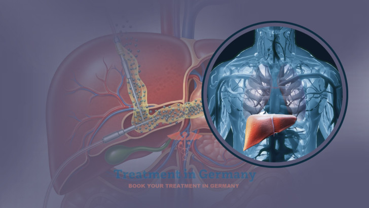 TACE Therapy for Liver Cancer in Germany
