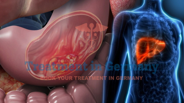 Dendritic Cell Therapy for Gastric Cancer with Liver Metastasis in Germany