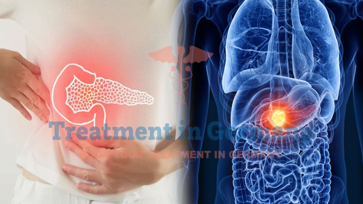 Pancreatic Cancer Treatment in Germany