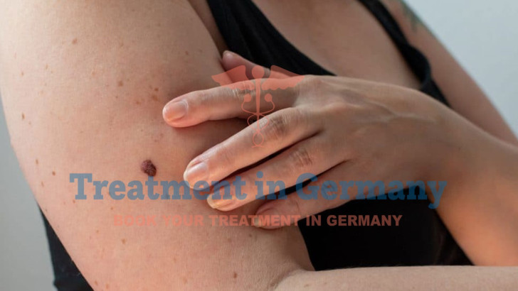Dendritic Cell Therapy for Melanoma Patients in Germany