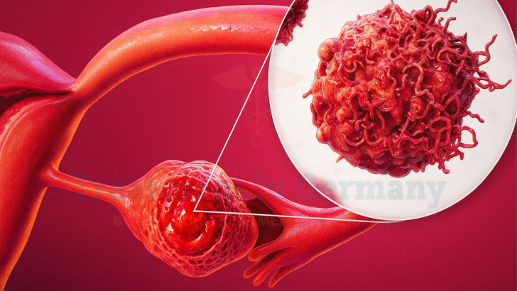 Treatment Options for Ovarian Cancer in Germany