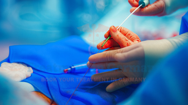 Cancer Treatment with TACE Therapy in Germany