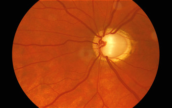 Optic Nerve Atrophy and treatment option