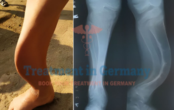 Rickets Treatment in Germany