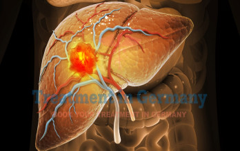 Advanced Liver Cancers Treatment in Germany