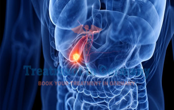 Advanced Gallbladder Cancer Treatment in Germany