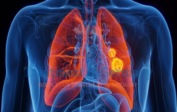 Advanced Stage 4 Lung Cancer Treatment in Germany