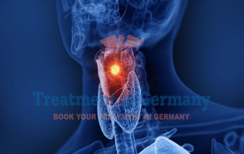 Throat Cancer Treatment in Germany: Advanced Options and Innovative Therapies