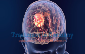 Latest Brain Cancer Treatment Options in Germany