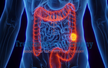 Colorectal Cancer: Full Treatment Guideline in Germany