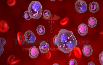 Can Dendritic Cell Therapy Enhance Multiple Myeloma Outcomes in Germany?