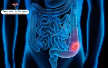 Pancreatic Cancer: Transforming Standards of Care in Germany’s Advanced Medical Landscape
