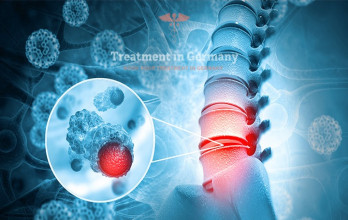 Bone Metastases: Comprehensive Guide to Advanced Treatment Options in Germany