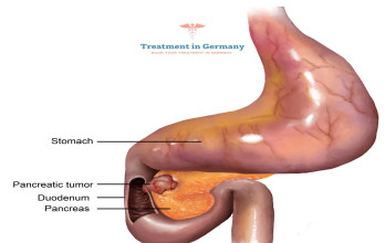 Hope for Pancreatic Cancer: Dendritic Cell Vaccines in German Clinical Trials