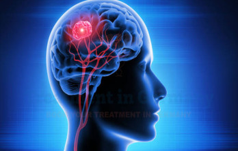 Glioblastoma Treatment In Germany