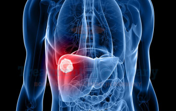 TACE for Liver Cancer in Germany