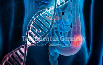 Colon cancer treatment with dendritic cells in Germany