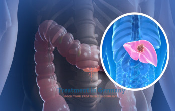 Treatment of colorectal liver metastases in Germany