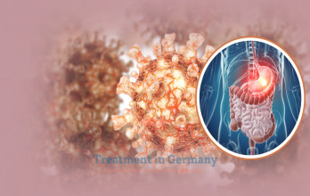 Dendritic Cell Therapy for Stage 4 Stomach Cancer in Germany