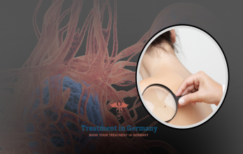 Skin Cancer Immunotherapy in Germany: The Role of Dendritic Cell Therapy