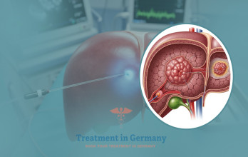 Liver Cancer Treatment Options in Germany