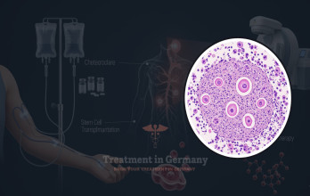 Hodgkin Lymphoma Treatment Options in Germany for USA Patients
