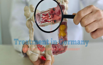 Dendritic Cell Therapy for Stage 4 Colorectal Cancer in Germany