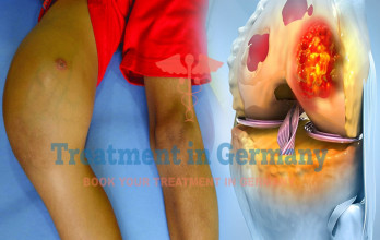 Dendritic Cell Therapy for Osteosarcoma Patients in Germany