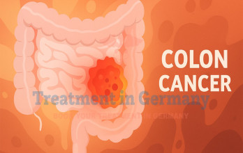 Colon Cancer Stage 4: Full 4 Stage Bowel Cancer Treatments Guide