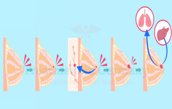 Breast Cancer Stages: Treatment Stage by Stage