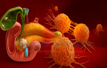 Pancreatic Cancer Treatment in Germany with Dendritic Cell-Based Immunotherapy