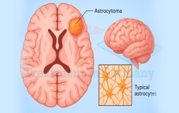 Brain Astrocytoma Treatment– Full Guide: All New Astrocytoma Treatment Options in Germany