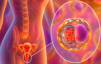 Treatment Options for Cervical Cancer in Germany