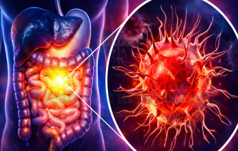 How Long Can a Stage 4 Colon Cancer Live?
