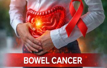 Stage 4 Bowel Cancer Treatment Options in Germany