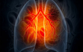 Immunotherapy Treatment for Stage 4 Lung Cancer